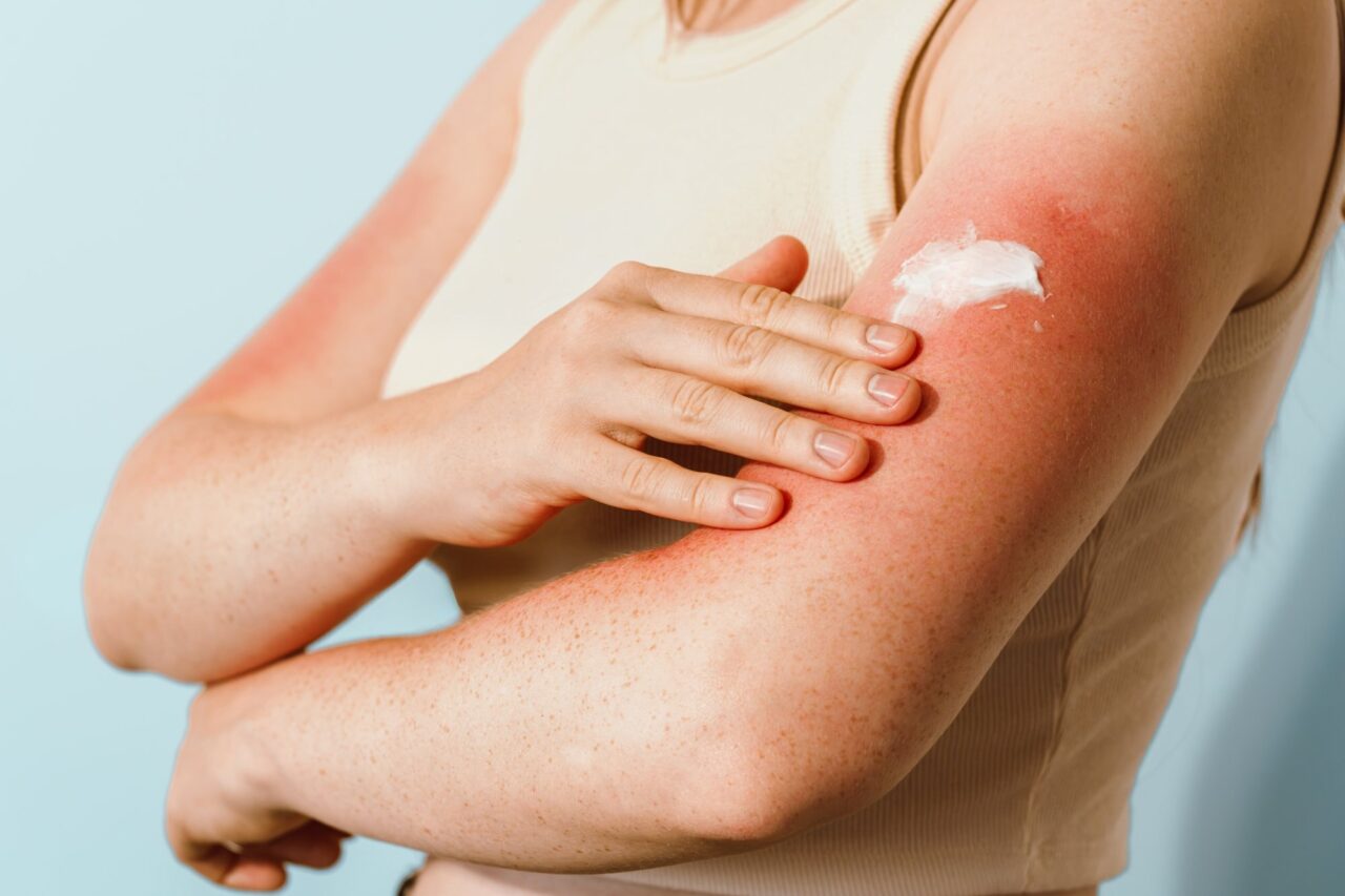Ce SPF alegi pentru pielea deschisă la culoare și sensibilă la soare